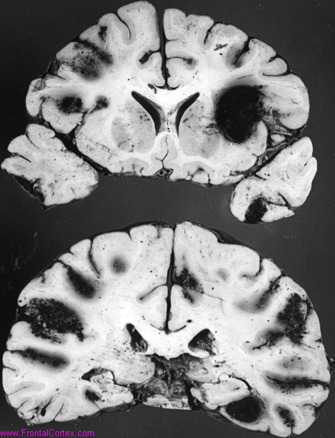 Arterial border zone infarcts with hemorrhagic transformation